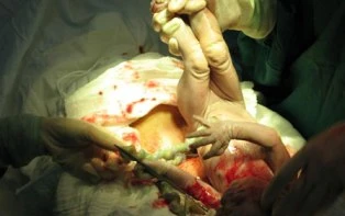 Nhiễm khuẩn nặng do bác sĩ quên gạc ảnh 1