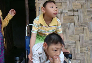 Hai trẻ bị bệnh lạ trông giống khỉ ảnh 1