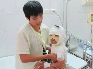 Phỏng 2 lần vì sơ cứu sai ảnh 1