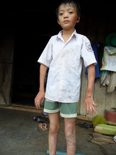 Cậu học trò người Dao khuyết tật hiếu học ảnh 2