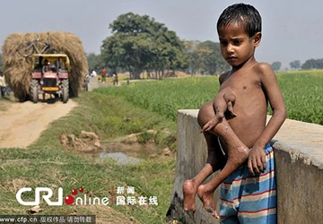 Cậu bé có 4 chân mọc ra từ bụng ảnh 1