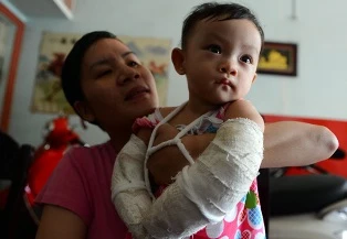 Nhà trường mầm non: Không biết vì sao bé gãy tay ảnh 1