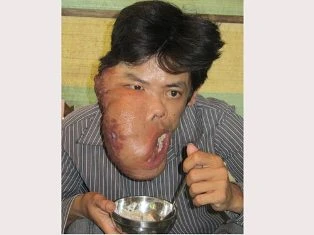 Bị bướu “ăn” nửa mặt ảnh 1