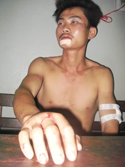 Tài xế Cường đang điều trị tại Bệnh viện Hóc Môn.