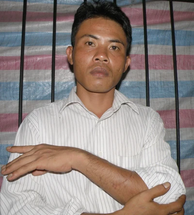 Bị chém đứt gân tay nhưng chưa được xử lý ảnh 1