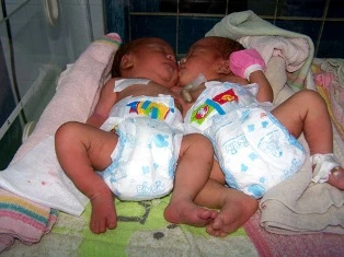 Trẻ song sinh dính nhau ảnh 1