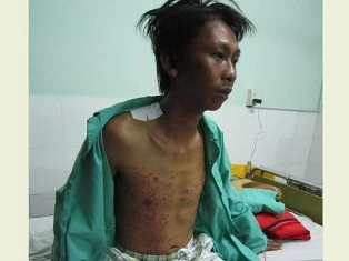 Bị ghim hàng trăm vết thương do nổ bình khí nén ảnh 1