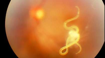 Giun chui lên mắt do ăn ốc sống ảnh 1