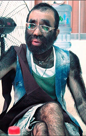 Người đóng Tây Du Ký chuẩn bị phẫu thuật lông ảnh 1