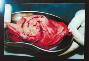 Bác sĩ quên vải xô trong bụng sản phụ ảnh 2