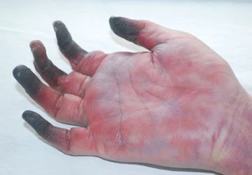 Điều trị tắc trách, một bệnh nhân sắp bị tháo khớp ảnh 1