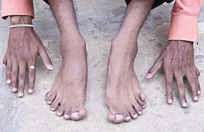 Đôi bàn tay, chân kỳ lạ của Heramb.