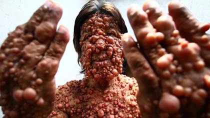 Người đàn ông biến dạng vì mụn mọc như sung ảnh 1