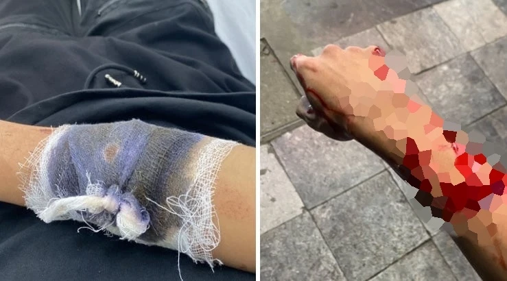 Đi xem Euro về, thiếu niên 17 tuổi bị nhóm cướp chém trọng thương và lấy đi xe máy