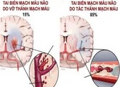 Tai biến mạch máu não: Cấp cứu thế nào để tránh tử vong?