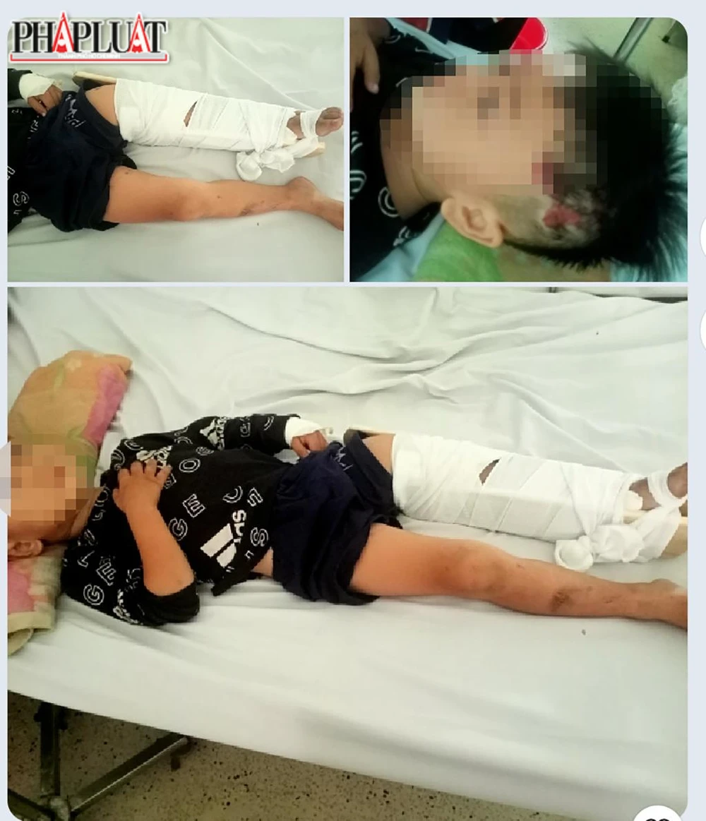 Theo gia đình, bé trai bị gãy chân, đầu xây xát nhưng không ảnh hưởng đến tính mạng. Ảnh: GĐCC Theo gia đình, bé trai bị gãy chân, đầu xây xát nhưng không ảnh hưởng đến tính mạng. Ảnh: GĐCC
