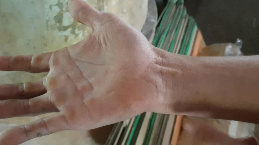 Trong một lần bất cẩn khi cho khỉ ăn, anh Dũng bị khỉ cắn gây ra vết sẹo dài. Ảnh: NT