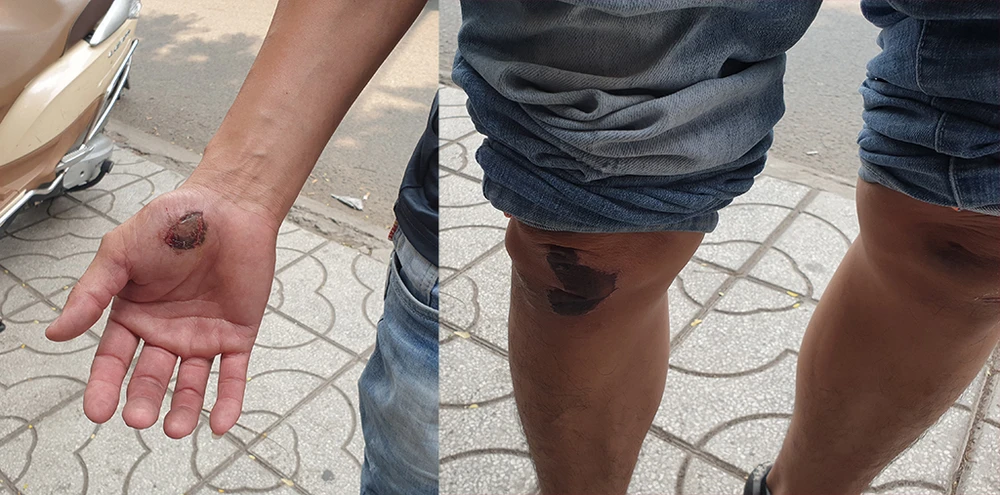 Sự việc khiến Nhân bị trầy xước ở tay, chân và mặt. Ảnh: NT