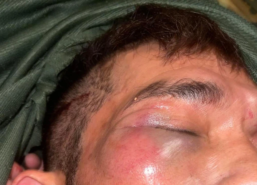 Nam ca sĩ bị thương ở mắt, rách phần đầu. Ảnh: ĐC Nam ca sĩ bị thương ở mắt, rách phần đầu. Ảnh: ĐC