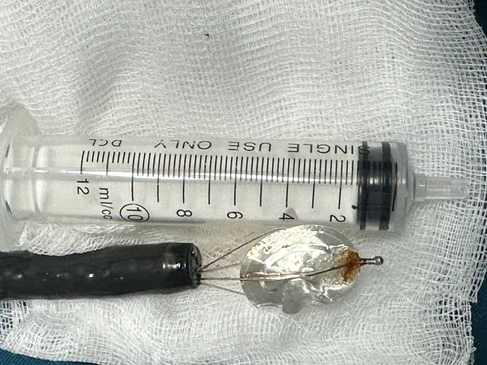 Cứu bé trai 11 tuổi nuốt nắp lon nước ngọt vào dạ dày