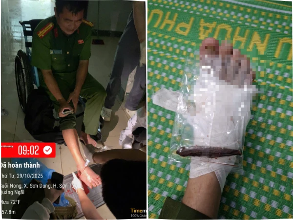 Trưởng Công an xã ở Quảng Ngãi bị gỗ đâm xuyên chân khi giúp dân chống lũ