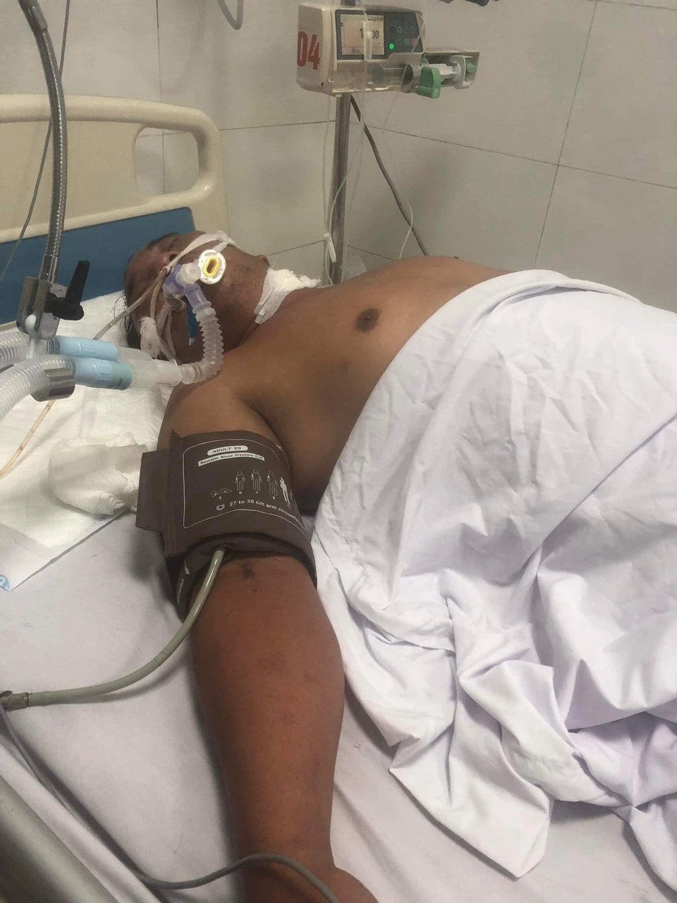 Nghi phạm Trần Đức Trình sau khi làm phẫu thuật tại bệnh viện Bạch Mai. Ảnh: GĐCC Nghi phạm Trần Đức Trình sau khi làm phẫu thuật tại bệnh viện Bạch Mai. Ảnh: GĐCC