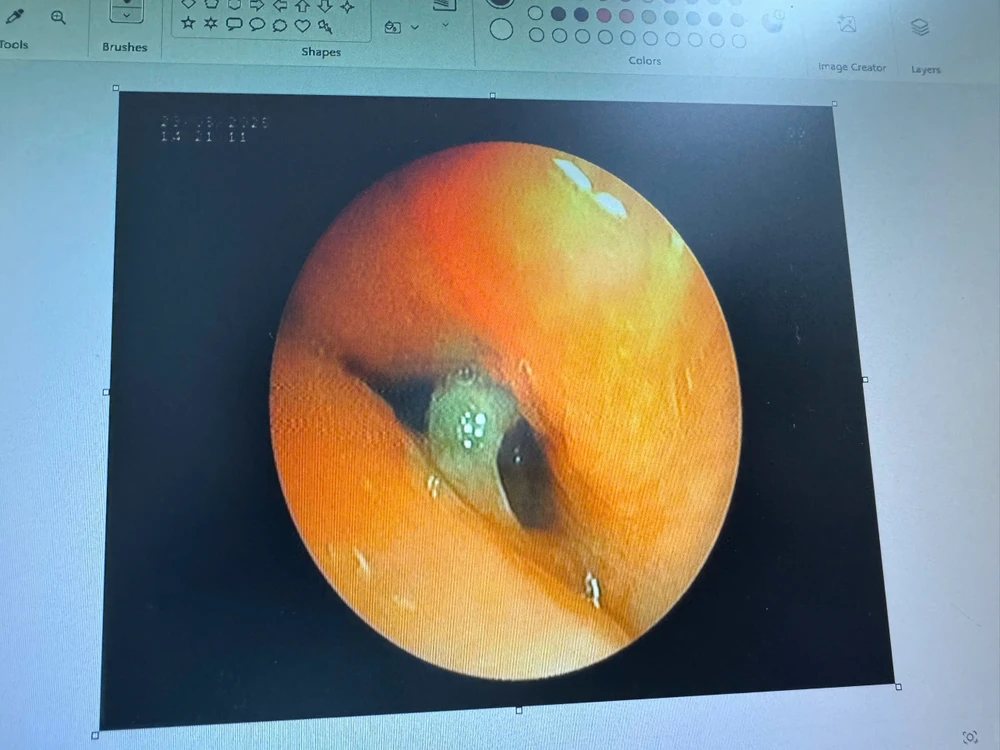 hình ảnh nội soi phế quản.jpg