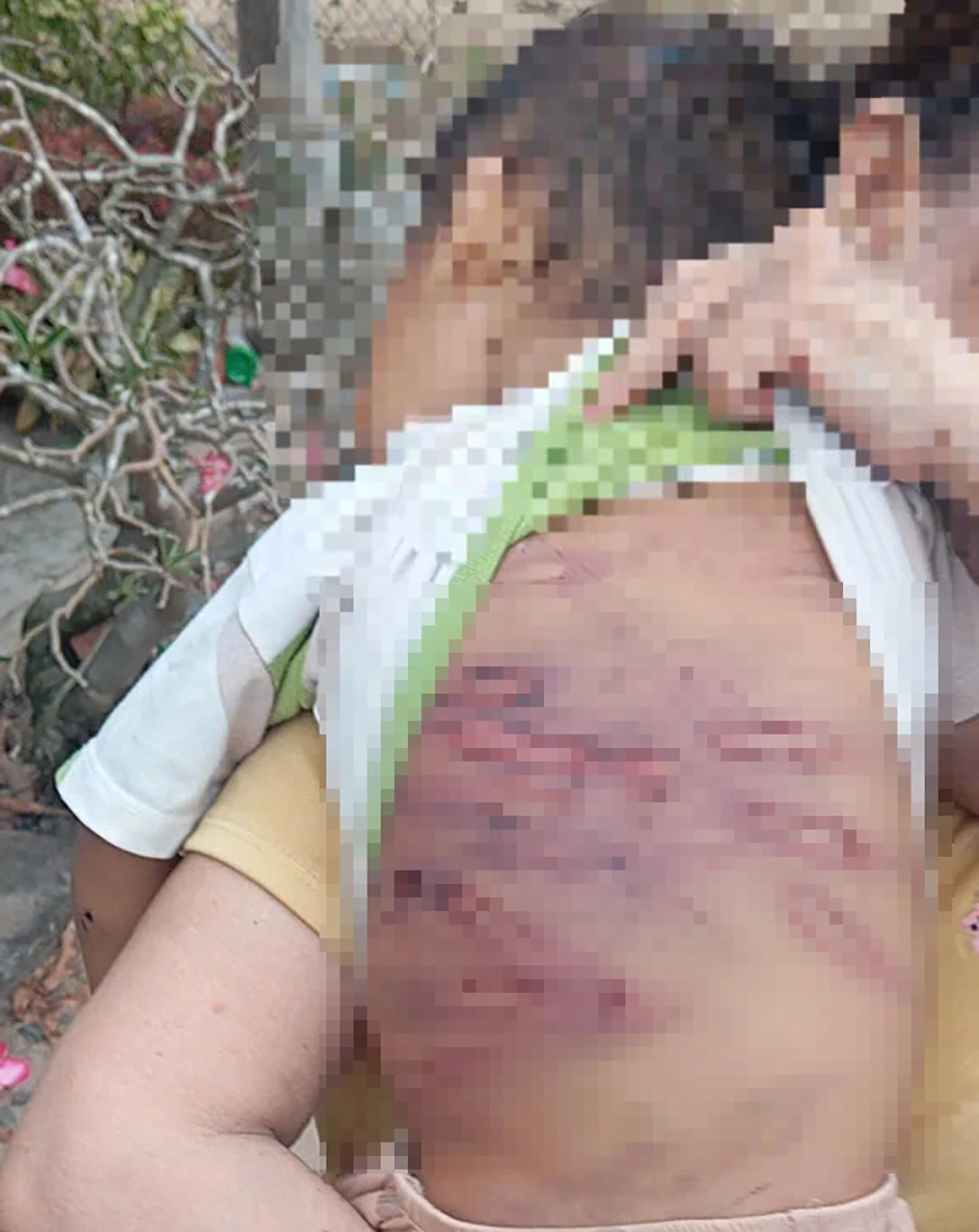 hinh-anh-vet-thuong-cua-chau-k-2-8356-9632.jpg