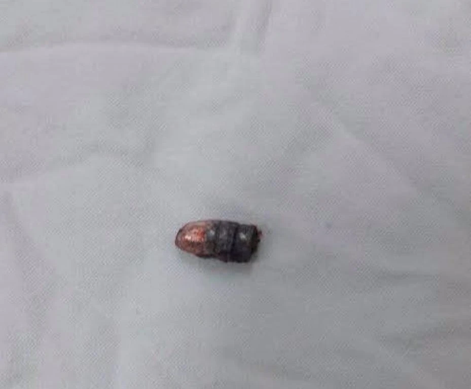 Đầu đạn lấy ra từ bàn tay anh Hùng