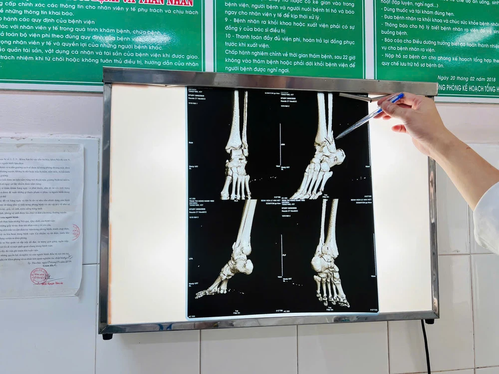 Phẫu thuật thành công ca gãy lún 3 mắt cá cổ chân khi nhảy dây