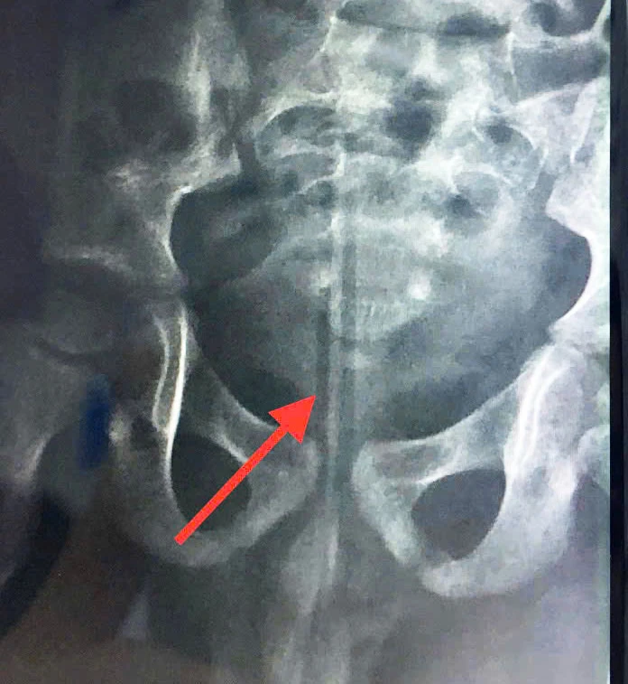 Bé trai 5 tuổi phải nhập viện vì nhét bút chì vào hậu môn