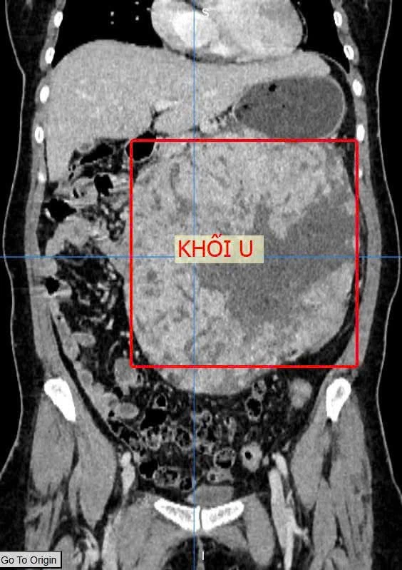 Phẫu thuật cắt bỏ khối u nặng hơn 3,5 kg cứu sống bệnh nhân
