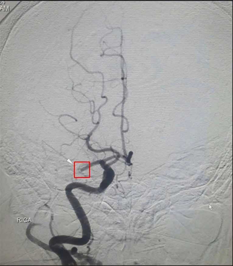 Kịp thời sống bệnh nhân nhồi máu não nguy kịch