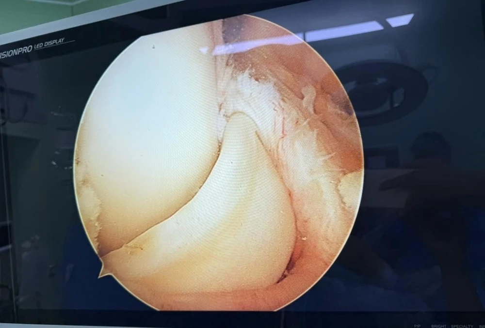 Người đàn ông bị rách sụn chêm dạng quai xách khi chơi đá banh