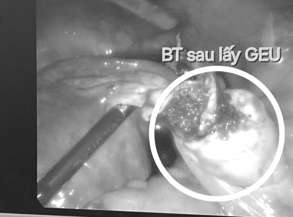 Cấp cứu thai phụ mang thai ngoài tử cung, giữ nguyên buồng trứng