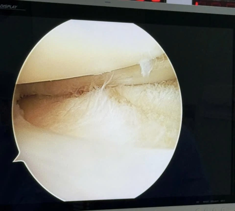 Tổn thương rách sụn chêm dạng quai xách.jpeg