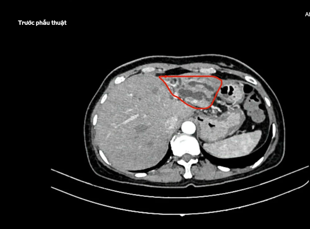 Người phụ nữ bị nhiễm trùng đường mật do sỏi, phải cắt bỏ một gần gan