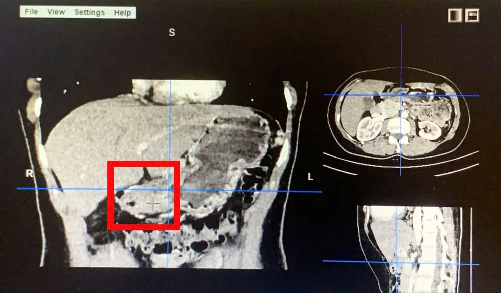 Phẫu thuật nội soi thành công điều trị ung thư dạ dày và nạo vét hạch cho bệnh nhân 43 tuổi