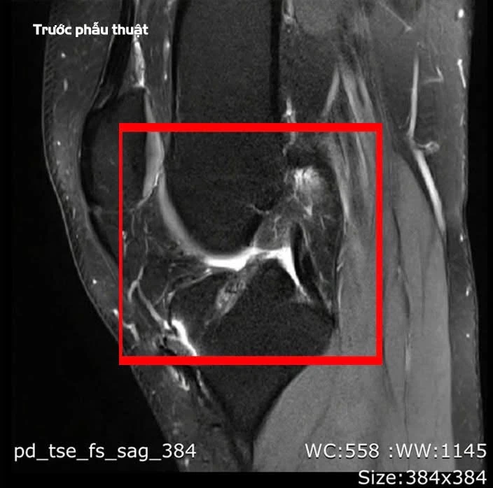 Chơi thể thao, nam thanh niên 27 tuổi 3 lần đứt dây chằng