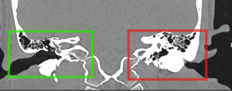Lồi xương ống tai khiến người phụ nữ 35 tuổi suy giảm thính lực