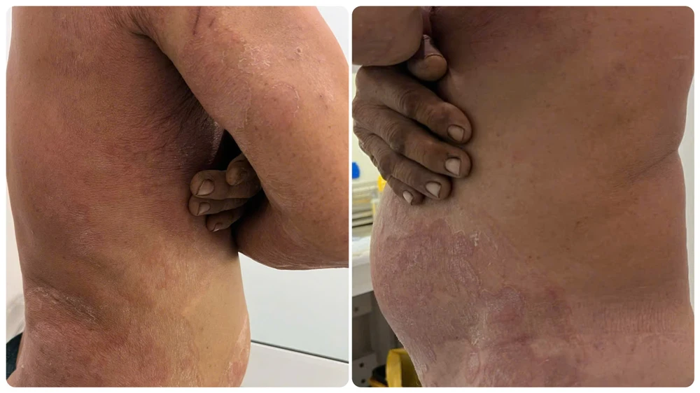 Nấm da toàn thân do tự điều trị mẩn ngứa