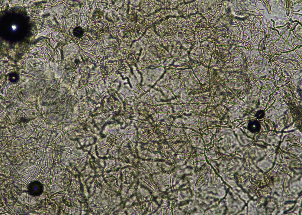 Nấm da toàn thân do tự điều trị mẩn ngứa