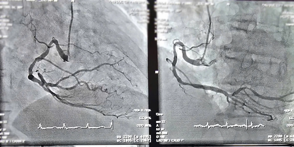Cụ ông 90 tuổi nguy kịch vì nhồi máu cơ tim