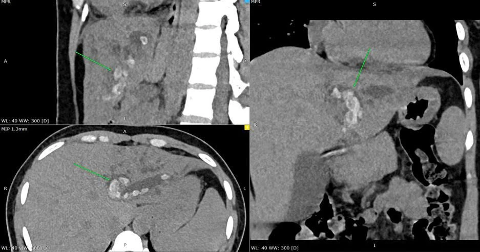 Đau bụng kéo dài, người phụ nữ bất ngờ vì ổ sỏi đường mật nằm sâu trong gan