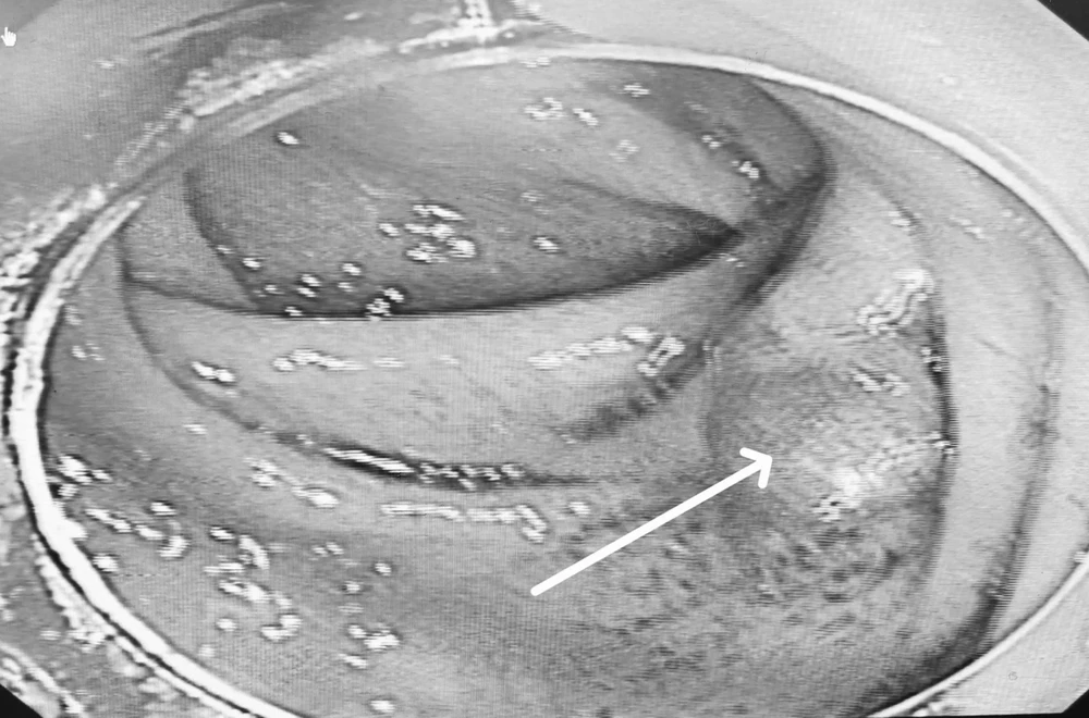 Đau bụng âm ỉ, nữ bệnh nhân phát hiện lồng ruột do khối u manh tràng