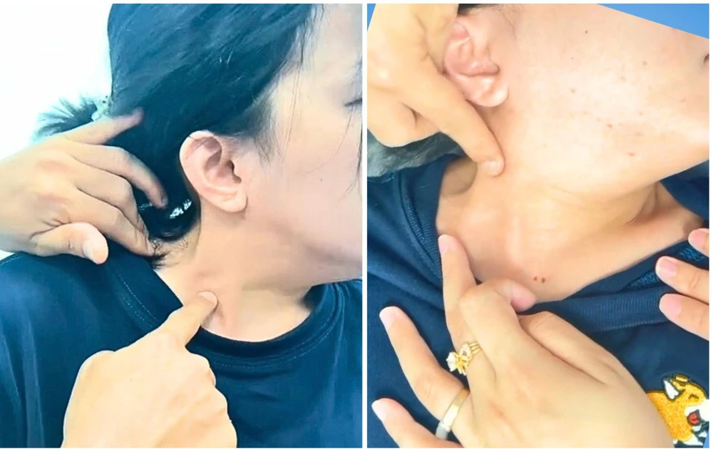 Cô gái 27 tuổi mất khả năng quay cổ vì mắc bệnh bẩm sinh hiếm gặp