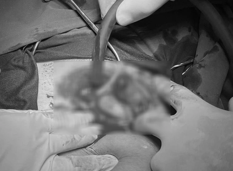 Sản phụ mang song thai, một trong, một ngoài tử cung