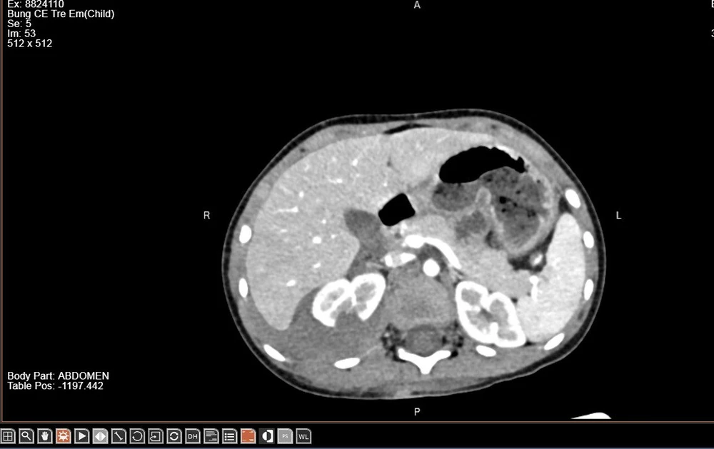 Bé 3 tuổi vỡ thận do bị chó béc-giê tấn công 2.jpg