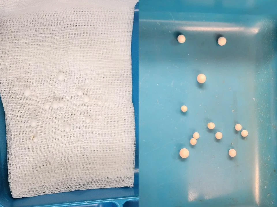 Bé trai 3 tuổi mắc 12 dị vật trong hốc mũi.jpg