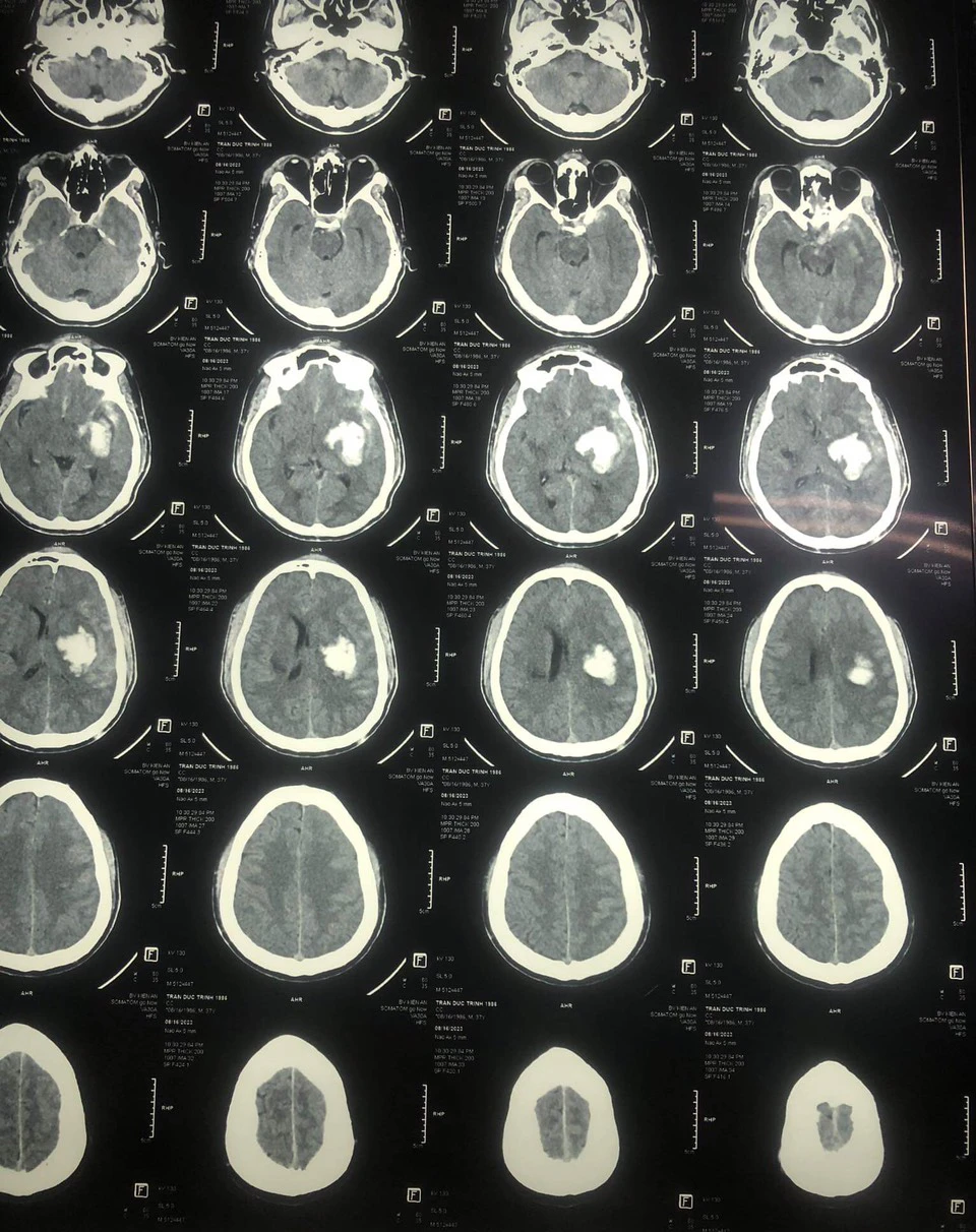 Hình ảnh chụp thương tích xuất huyết bán cầu trái của bệnh nhân Trần Đức Trình Hình ảnh chụp thương tích xuất huyết bán cầu trái của bệnh nhân Trần Đức Trình